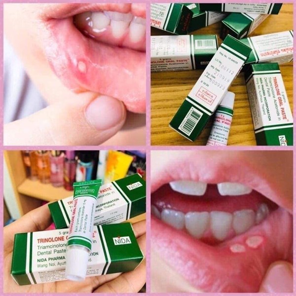 Kem bôi nhiệt miệng thái